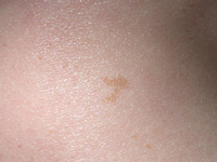 my birthmark