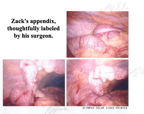 Zack's appendix.